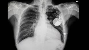 pulmonary edema causes