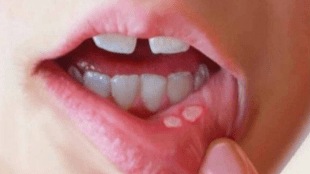 White Red Mouth ulcer Swelling Easy Home Remedies by using Ghee Tulsi leaves on Indigestion Cholestrol