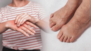 Swelling Hand Legs Face Due To Uric Acid Can Be Controlled With Vitamin C Rich Fruits Home Remedies