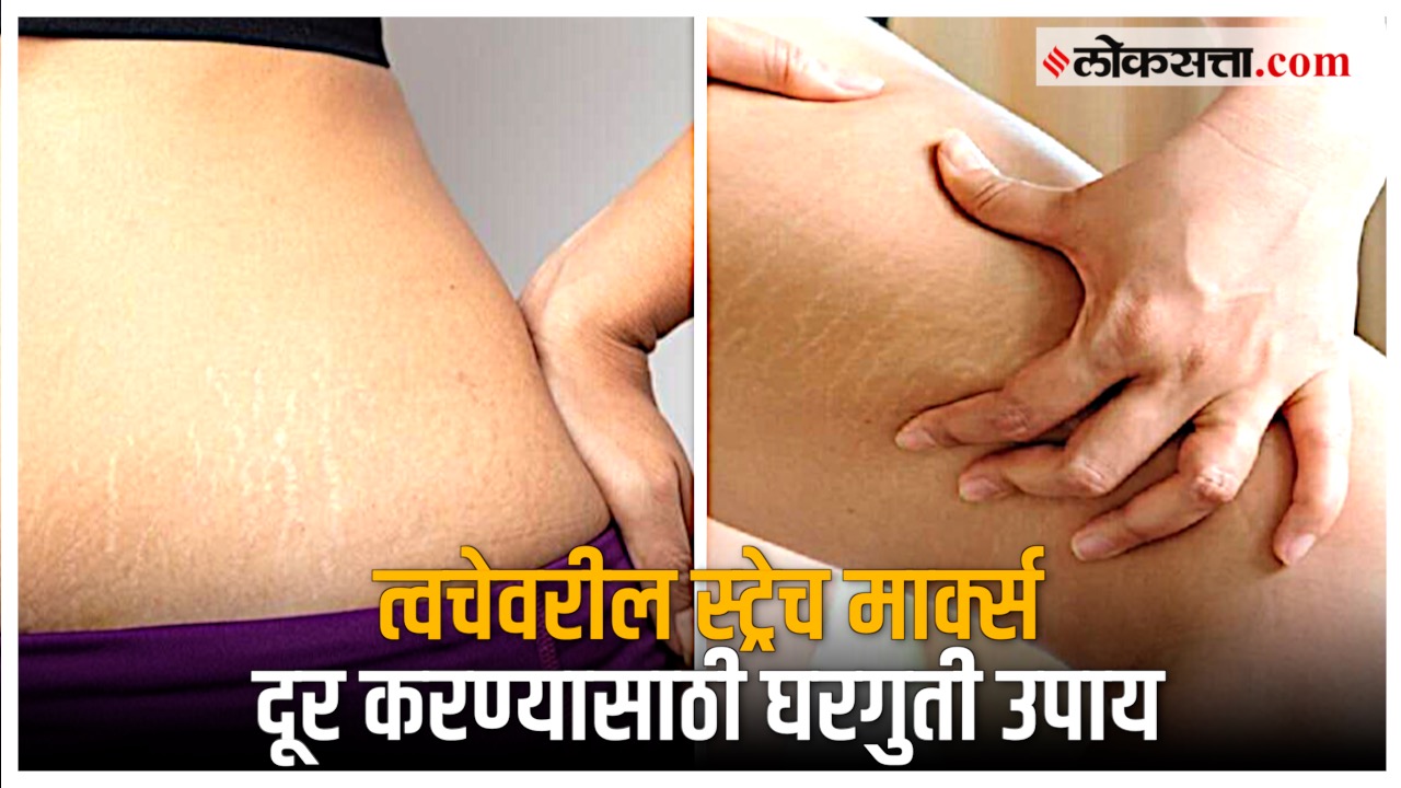 tips to remove stretch marks