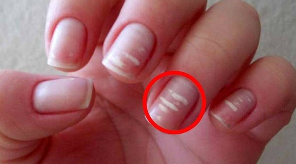 white spot on nails white spot on nails