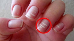 white spot on nails