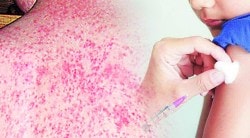 मुंबईकरांच्या चिंतेत भर! शहरात अचानक पसरली गोवरची साथ, तीन बालकांचा मृत्यू, आजाराची लक्षणे आणि उपाय जाणून घ्या