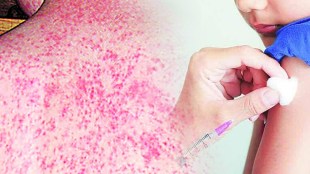 Mumbai Measles Treatment