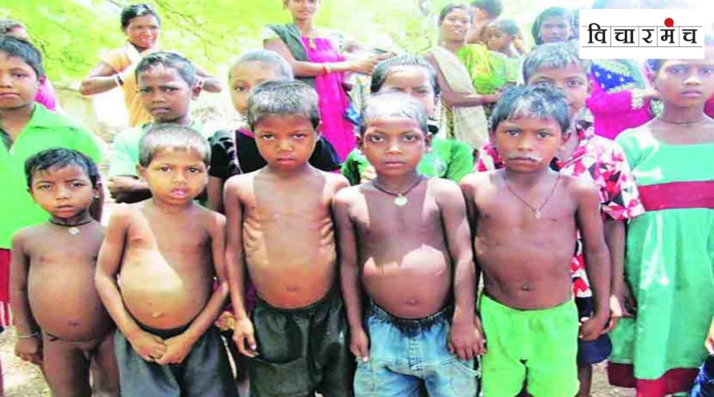 Malnutrition rates in india Malnutrition rates in india