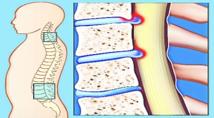 lekh back pain