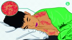 Measles Disease: लहान मुलांमध्ये गोवरचा उद्रेक, ‘अशी’ घ्या काळजी!