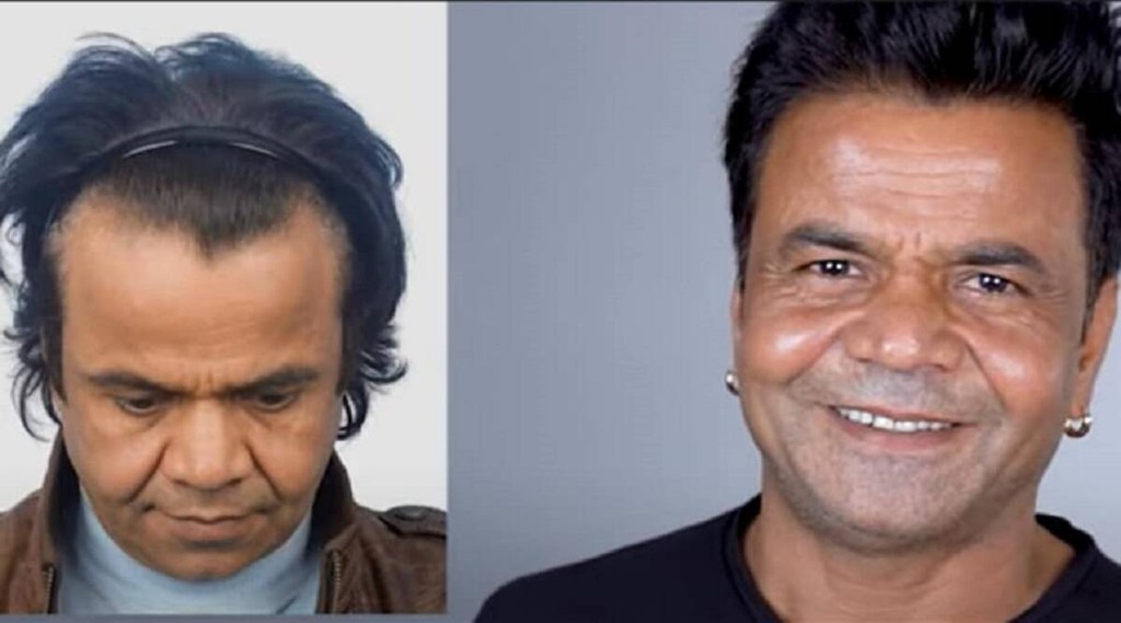 rajpal yadavhair transplant
