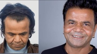 rajpal yadavhair transplant