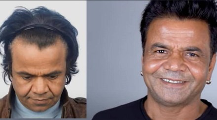 rajpal yadavhair transplant