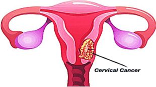 cervical cancer