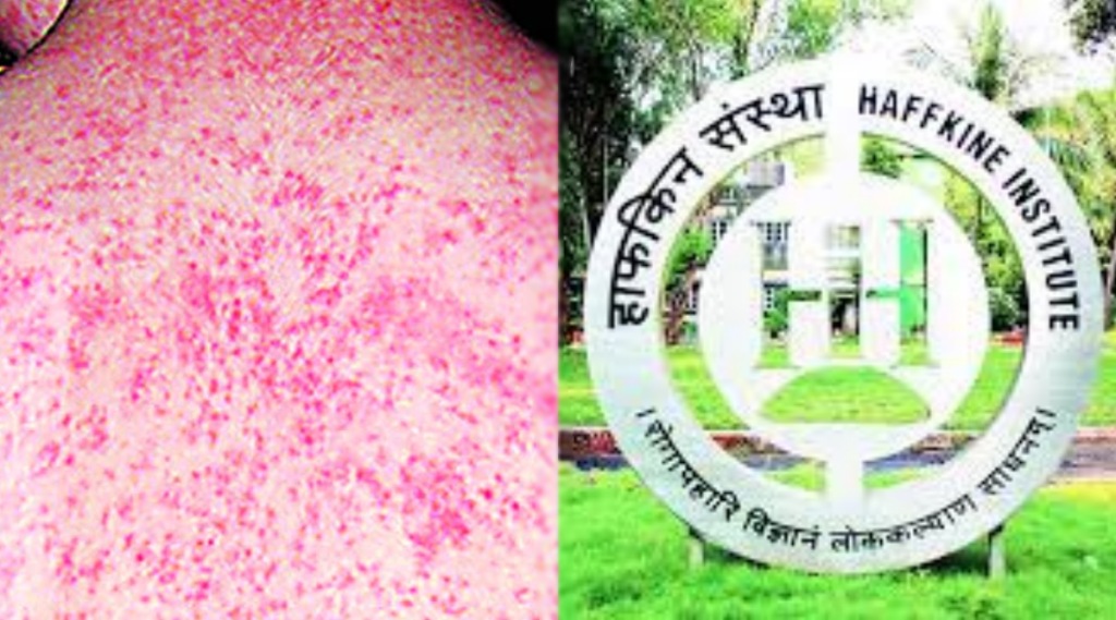 गोवर रुग्णांच्या नमुन्यांच्या तपासणीसाठी हाफकीन तयार