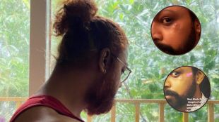 devdatta nage injured marathi actor