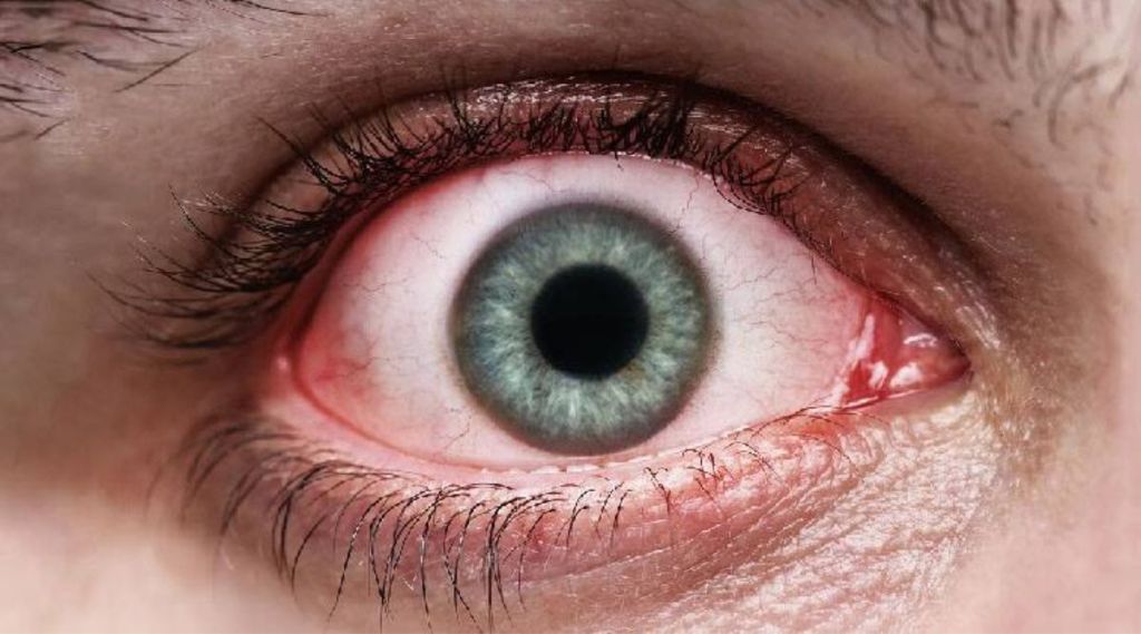 red eyes symptoms red eyes symptoms
