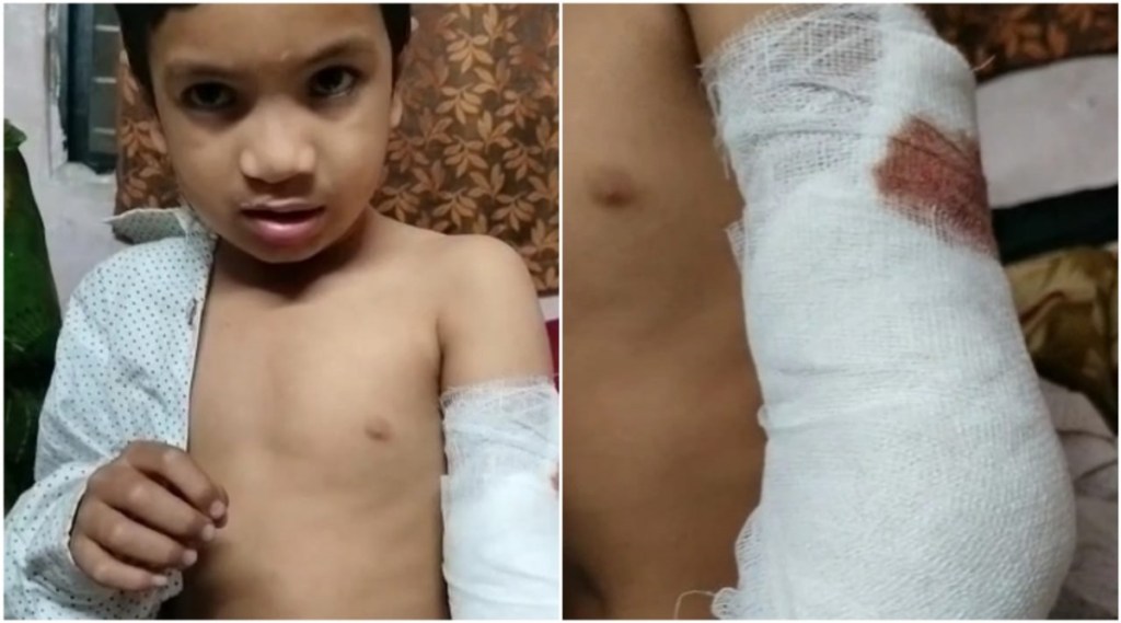a stray dog attack on 6 year boy in Pimpri pune
