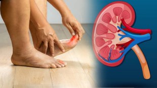 high uric acid causes kidney failure