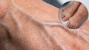 swollen veins
