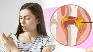 gout problem