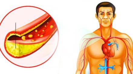 bad cholesterol sign