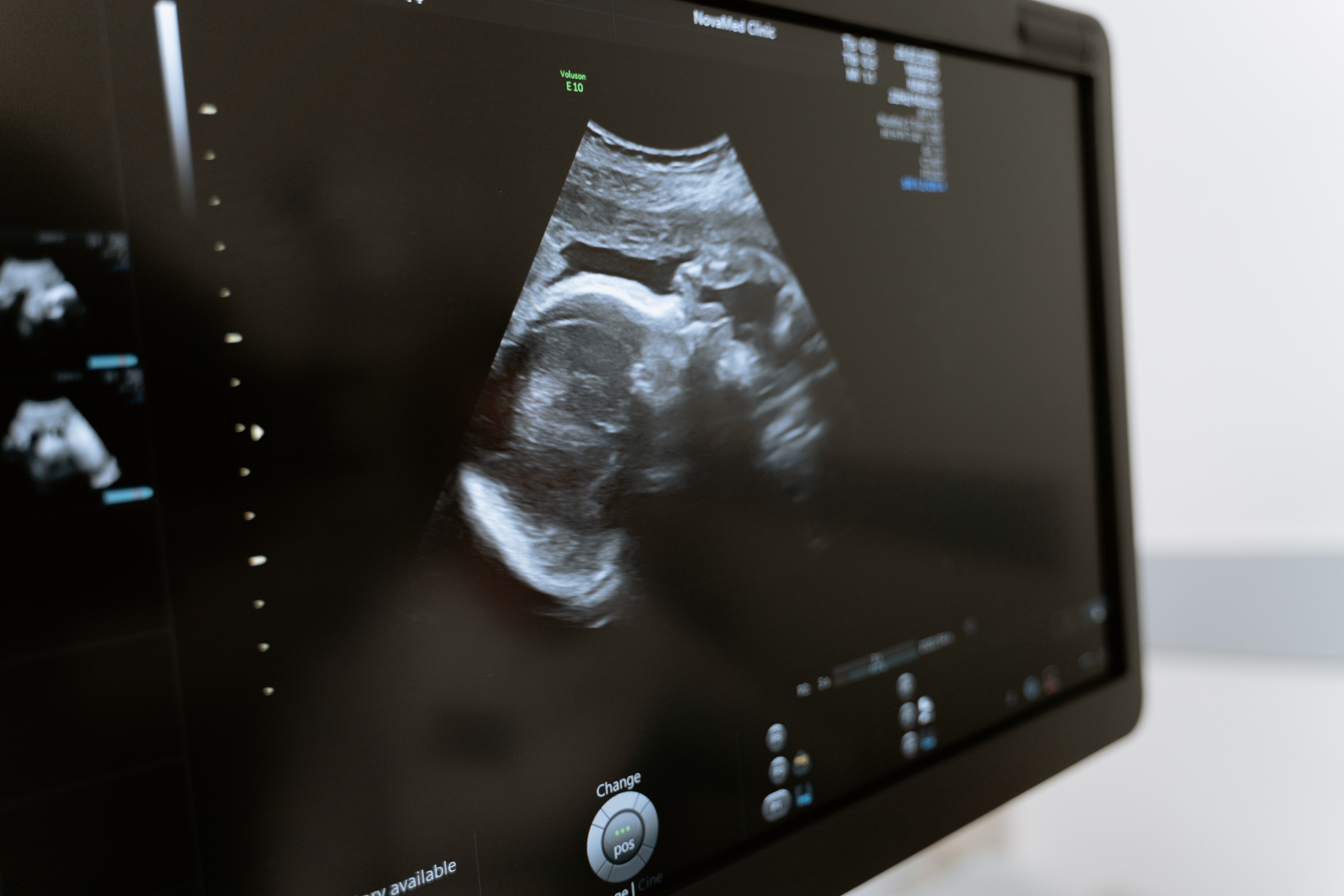 Drinking While Pregnancy Risks