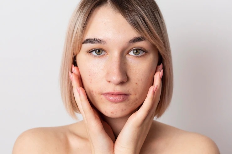 sleeping mistakes cause pimples