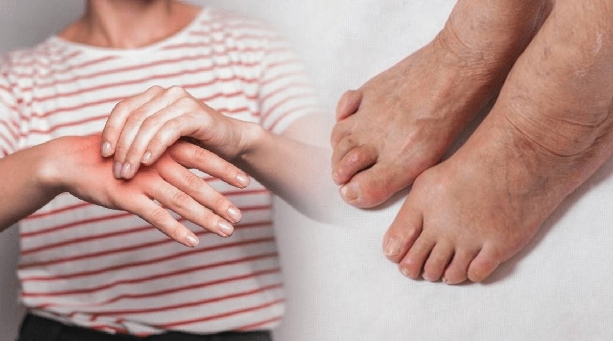 Tips to control uric acid