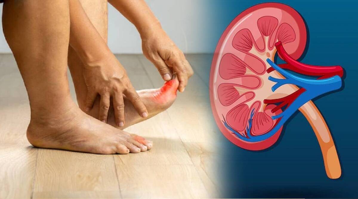 Tips to control uric acid