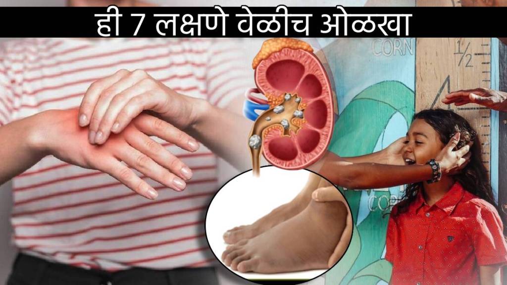 Chronic Kidney Failure Shows This Seven Signs In Body Before Kidney Stops Working How To Identify Danger In Kids Health News Chronic Kidney Failure Shows This Seven Signs In Body Before Kidney Stops Working How To Identify Danger In Kids Health News