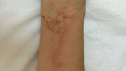 parasitic worm infections