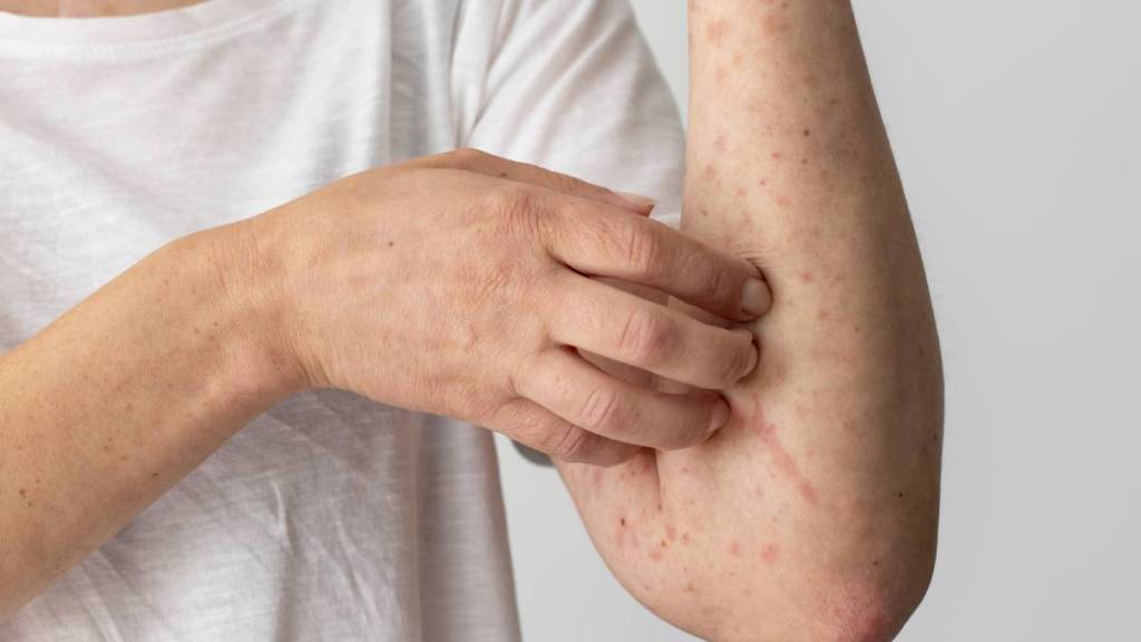 home remedies for prickly heat Rashes and Sunburns
