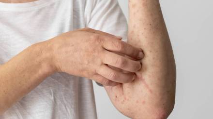 home remedies for prickly heat Rashes and Sunburns