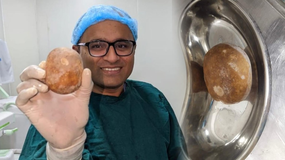 kidney stone removed