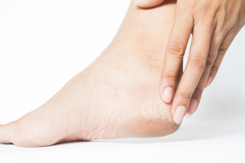 हात, घोटा किंवा पायांना सूज येणे (Edema) (Freepik)