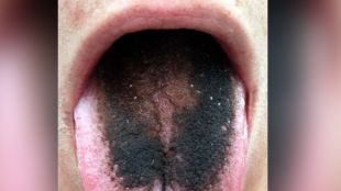 Black Hairy Tongue syndrome
