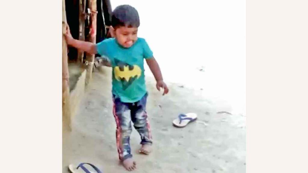 baby born with bow legs
