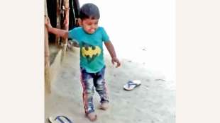 baby born with bow legs