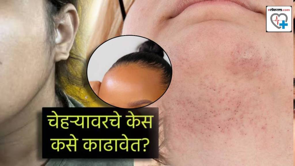 Facial Hair Removal Why Do Women get Hair On Face Like Beard but Same Time Hair Line Goes Back From Forehead PCOS Cure Facial Hair Removal Why Do Women get Hair On Face Like Beard but Same Time Hair Line Goes Back From Forehead PCOS Cure