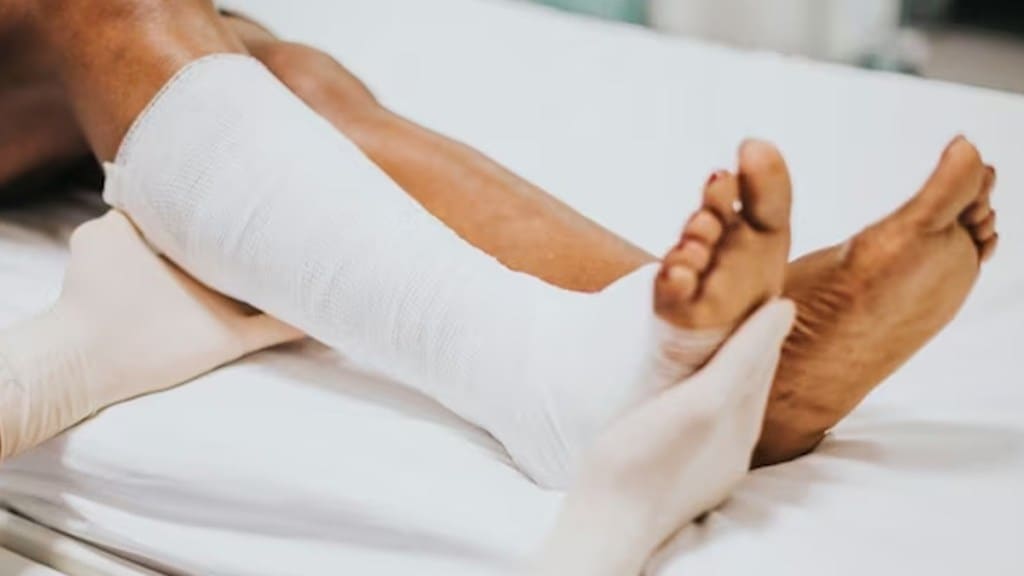 leg fracture leg fracture