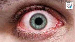 Conjunctivitis crowded places