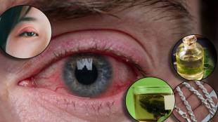 Dole Yene Eye Flu Signs And Home Remedies How To Keep Eyes Clean And Safe During Conjunctivitis Spread In Maharashtra