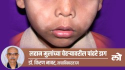 Health Special: लहान मुलांच्या चेहऱ्यावरील पांढऱ्या डागांचं काय करायचं?