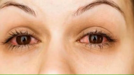 conjunctivitis cases in maharashtra