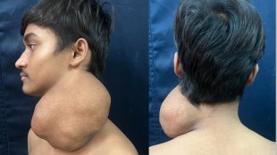 1.5 kg tumor on neck, tumor from neck removed after surgery