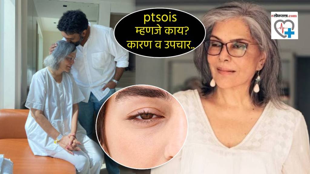 Zeenat Aman diagnosed with ptosis Eyelids Disease Hanging Loose on Eye Problem Signs Symptoms Precaution Should You care