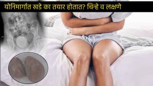 27 Year Old Lady had Orange Sized Stone In Vagina Same Like Kidney Stone Check Signs Of Urine Stone In Vagina Care In Marathi