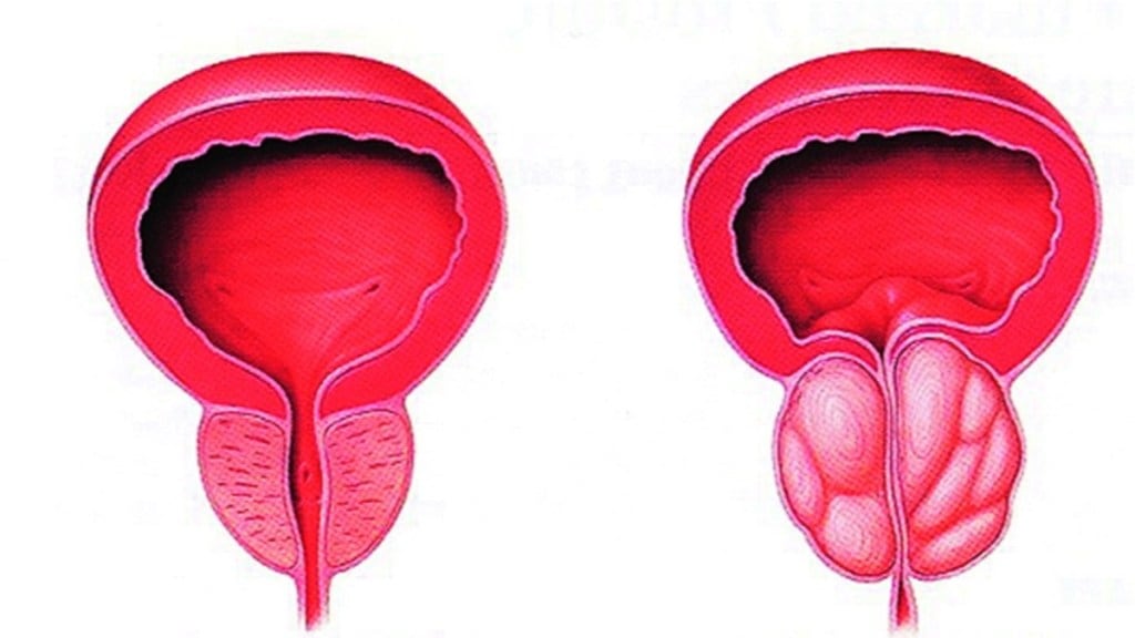 treatment on prostate gland pune news in marathi, prostate gland treatment news in marathi treatment on prostate gland pune news in marathi, prostate gland treatment news in marathi