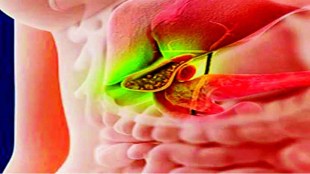 bmc hospital latest news in marathi, obstructions in bile ducts of children news in marathi