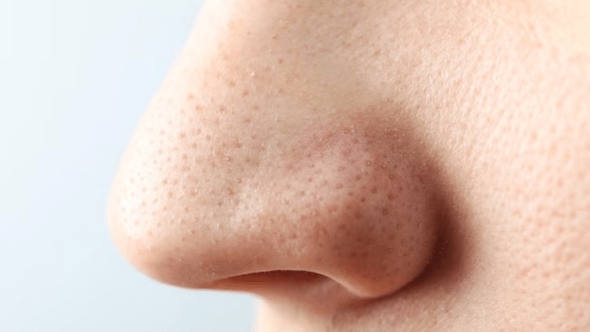 Best Home Remedies To Get Rid Of Black Rids At Nose