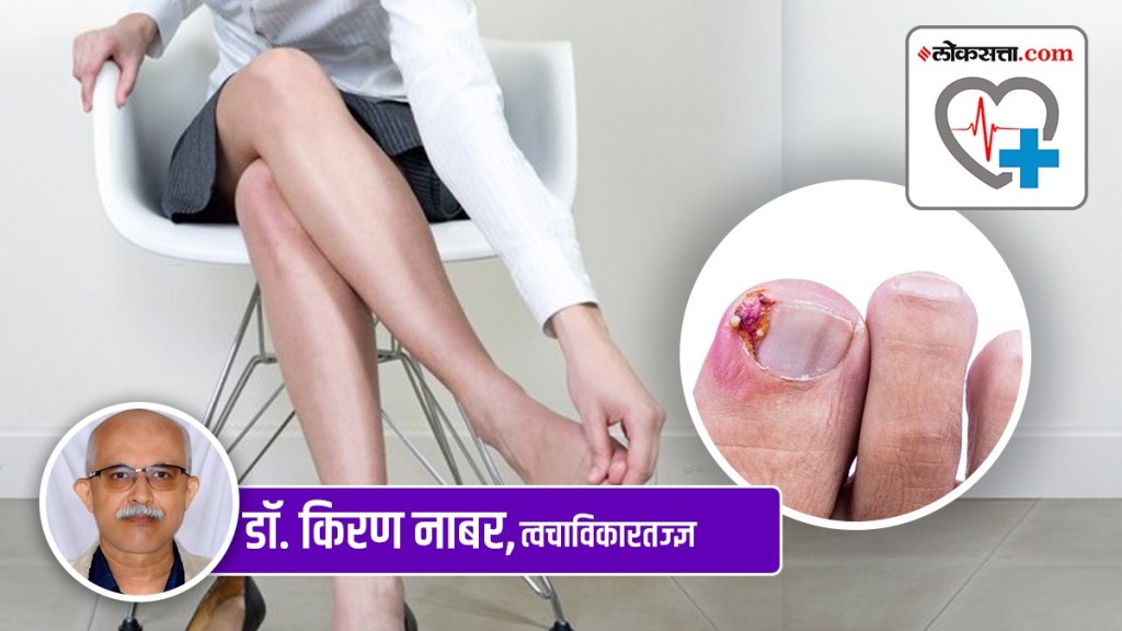 ingrowing toenail ingrowing toenail