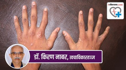 scabies marathi news, scabies symptoms marathi news,